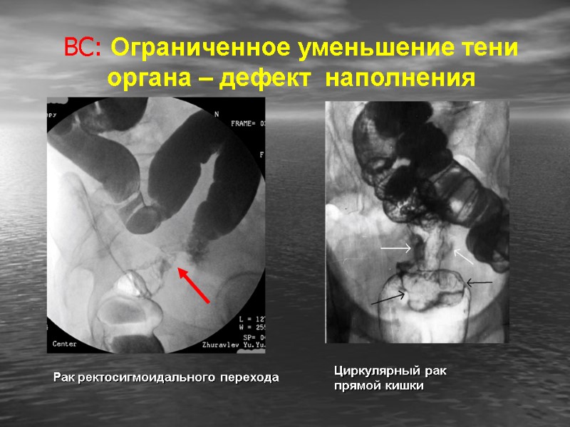 ВС: Ограниченное уменьшение тени органа – дефект  наполнения Циркулярный рак прямой кишки Рак
